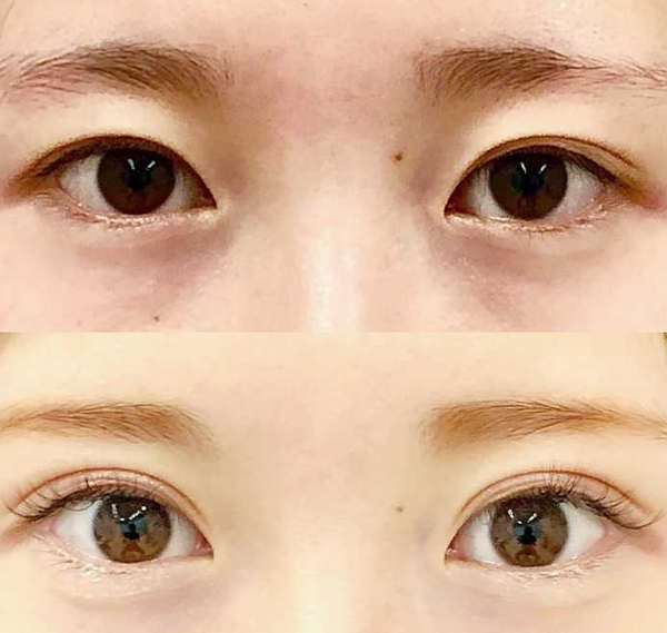 西京醫院雙眼皮價格多少